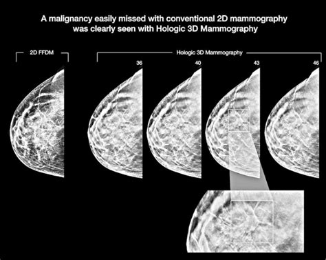 leesburg breast cancer mammogram images|Mammogram images: Normal, abnormal, and breast cancer .